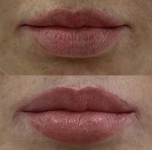 Пластика губ «Кессельринг» до и после первичная реабилитация. Работа Анны Петровны Першуковой