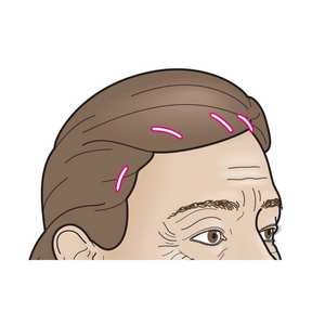 Локация мини-разрезов в волосистой части головы
