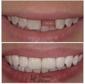 Имплантация центрального зуба до и после