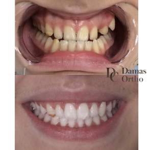 Ортодонтическое лечение до и после