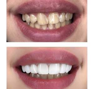 Композитные реставрации зубов до и после