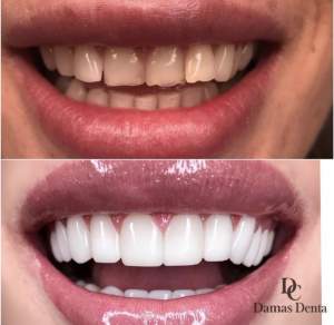 Композитные реставрации зубов до и после