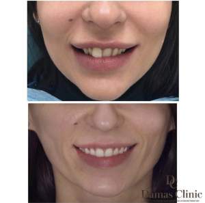 Лечение брекетами зубов результат до и после