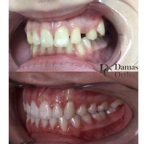 Лечение брекетами с перемещением зубов до и после