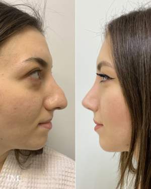 Третичная ринопластика с реконструцией носа до и через 6 месяцев после операции. Работа доктора Лины Алиевны Исбир