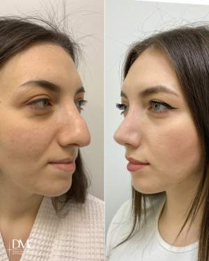 Третичная ринопластика с реконструцией носа до и через 6 месяцев после операции. Работа доктора Лины Алиевны Исбир
