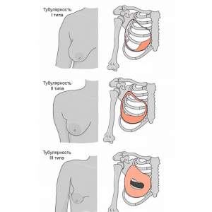 Типы тубулярности груди