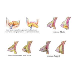 Техники коррекции тубулярности груди методом установки импланта