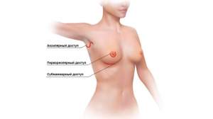 Типы хирургических доступов при проведении пластики груди