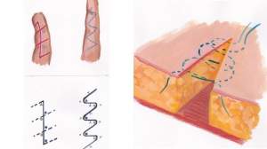 Техники хирургического удаления шрамов