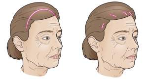 Варианты хирургического доступа к тканям верхней трети лица