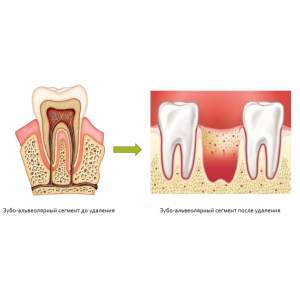 Зубо-альвеолярный сегмент до и после удаления