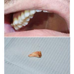 Хирургическое удаление зуба