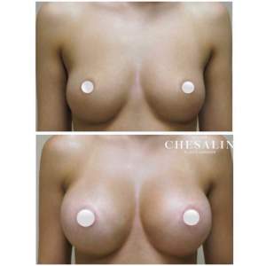 Увеличение груди имплантами. Фото до и после. Иван Павлович Чесалин