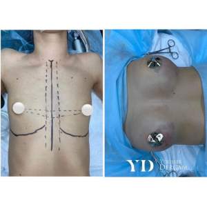 Увеличение груди имплантами. Фото до и после. Юссеф Дергам