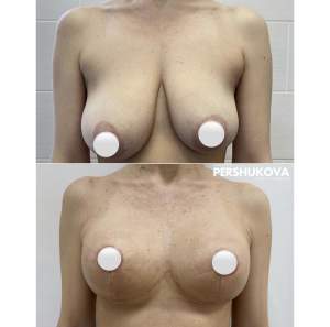 Якорная подтяжка груди с сохранением объема: до и через месяц после операции. Работа Анны Петровны Першуковой