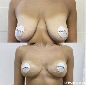 Якорная подтяжка груди с сохранением объема: до и через 1,5 месяца после операции. Работа Анны Петровны Першуковой