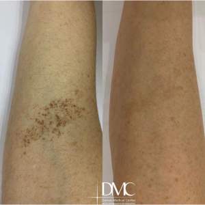 One session of pigmentation removal on the M22 device