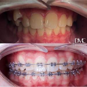 Intermediate result of braces treatment