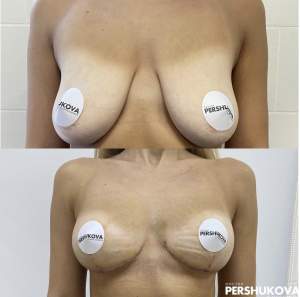 Якорная подтяжка груди с сохранением объема груди (без имплантов) до и через 1,5 месяца. Работа Анны Петровны Першуковой