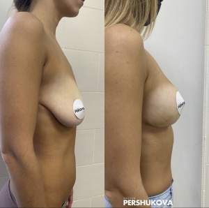 Якорная подтяжка груди с сохранением объема груди (без имплантов) до и через 1,5 месяца. Работа Анны Петровны Першуковой