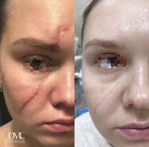 Удаление шрама на лице: результат до и после в промежуточном этапе