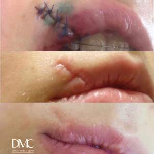 Удаление шрама над губой в промежуточном этапе