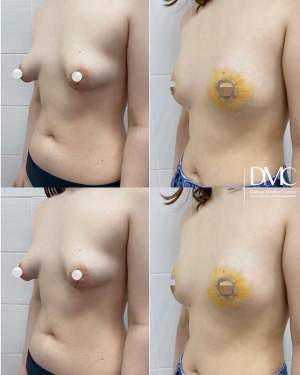 Арелярная подтяжка тубулярной груди: до и на 6 стуки после. Работа Анны Петровны Першуковой