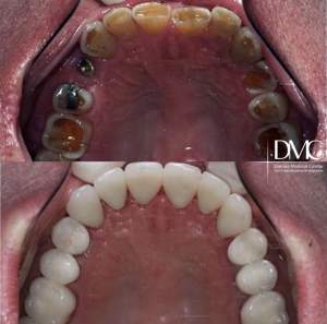 Комплексная работа с имплантацией зубов, установкой цельнокерамических коронок: до и после