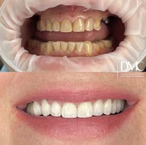 Комплексная работа с имплантацией зубов, установкой цельнокерамических коронок и виниров: до и после