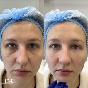 Коррекция носослезной борозды: до и сразу после процедуры