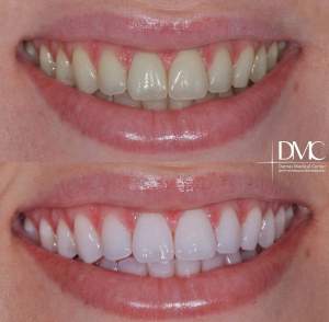 Отбеливание зубов системой ZOOM 4: до и после