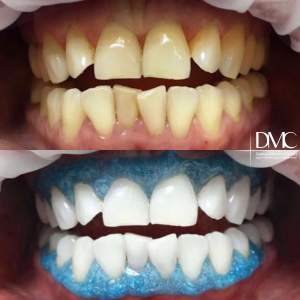 Отбеливание зубов системой ZOOM 4: до и после
