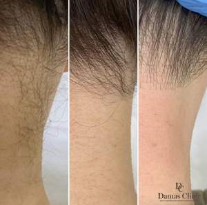 Эпиляция линии роста волос зоны шеи до и после