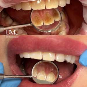 Гигиеническая комплексная чистка зубов (до и после).