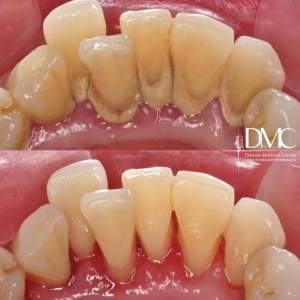 Гигиентическая комплексная чистка зубов (до и после).