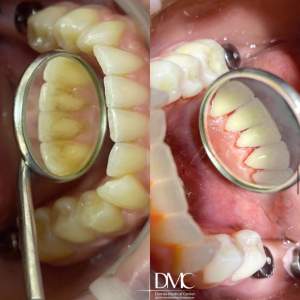 Гигиеническая комплексная чистка зубов   отбеливание ZOOM 4.