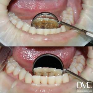 Гигиеническая комплексная чистка зубов (до и после).