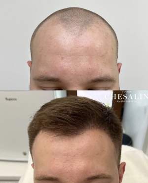 Результат трансплантации волос в височно - лобную зону через 4 месяца после пересадки