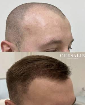 Результат трансплантации волос в височно - лобную зону через 4 месяца после пересадки