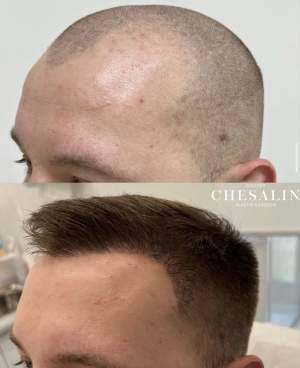 Результат трансплантации волос в височно - лобную зону через 4 месяца после пересадки. Работа доктора Ивана Павловича Чесалина