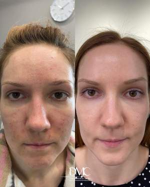 Лечение кожи методом лазерной шлифовки лица
