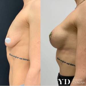 Увеличение груди имплантами (до и через месяц после операции)