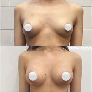 Коррекция тубулярной груди с одномоментным увеличением имплантами