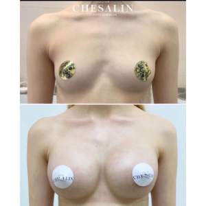 Увеличение груди анатомическими имплантами до и после первичной реабилитации