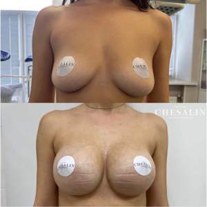 Увеличение груди имплантами с коррекцией асимметрии (до и через 4 недели после операции)