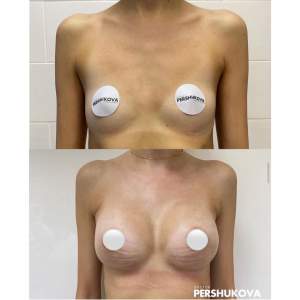 Сложная имплантация груди анатомическими имплантами (до и после)