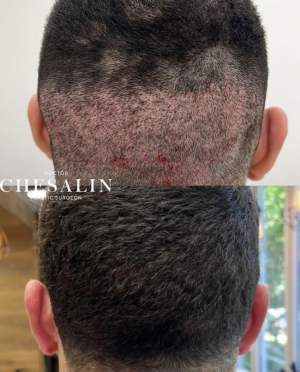 Демонстрация донорской зоны, результат восстановления через 25 дней после трансплантации волос. Работа Ивана Павловича Чесалина