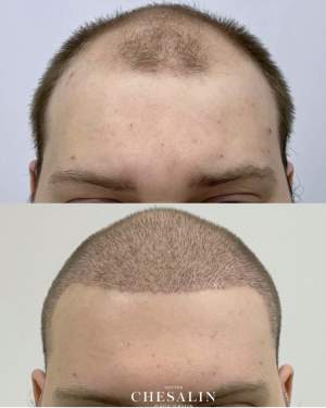 Фото до и на 8 сутки после трансплантации волос в височно-лобную зону и зону макушки. Работа Ивана Павловича Чесалина