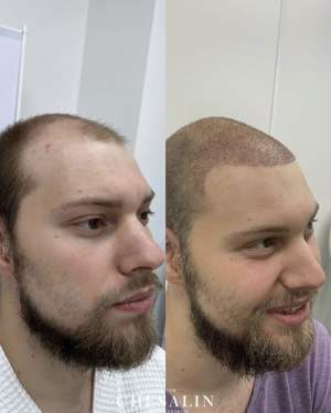 Фото до и на 8 сутки после трансплантации волос в височно-лобную зону и зону макушки. Работа Ивана Павловича Чесалина